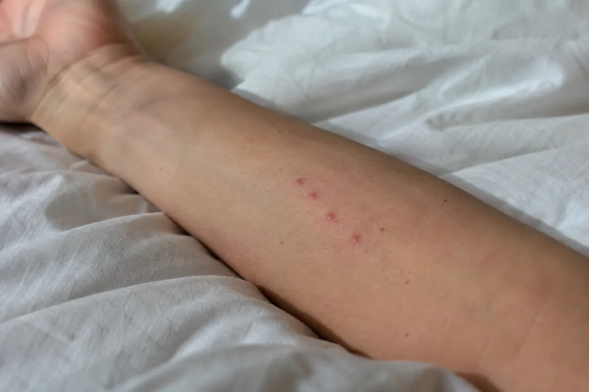 Forearm resting on white sheets with a short line of small red bites