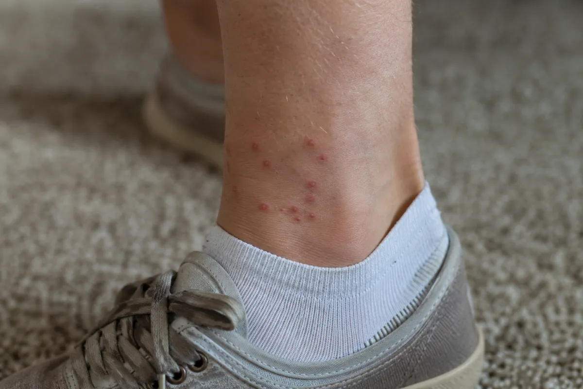 Small red bites around an ankle just above a sock